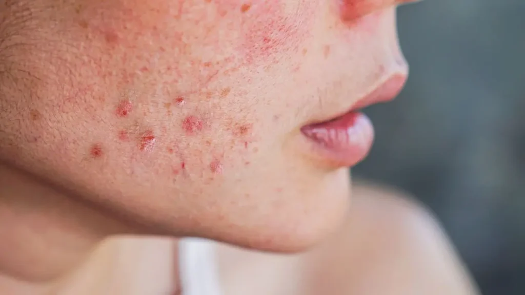 sensitive summer skin